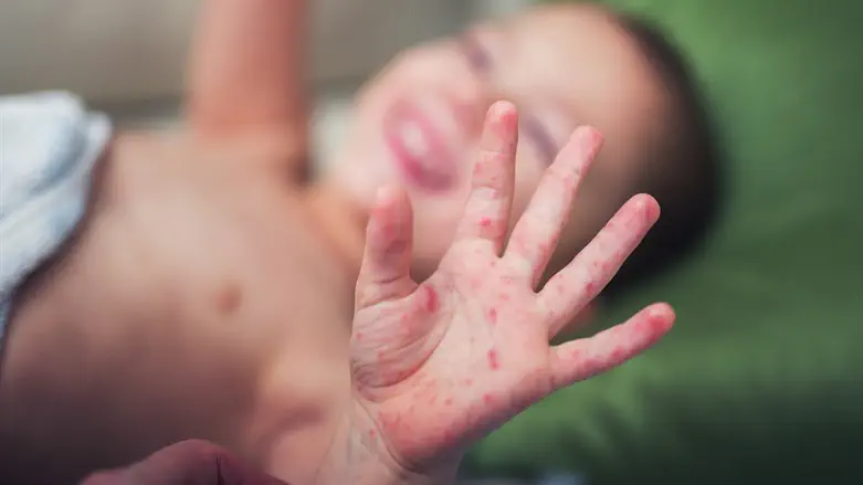 Measles (illustrative)
