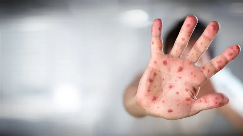 Measles