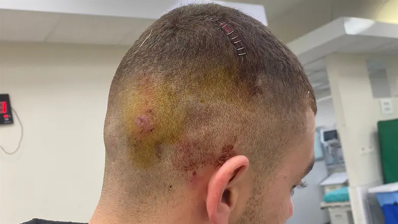 הצלקות יישארו לכל החיים