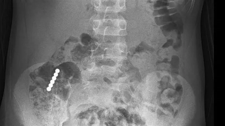 משחק מסוכן: ילד בן 9 שבלע שישה מגנטים