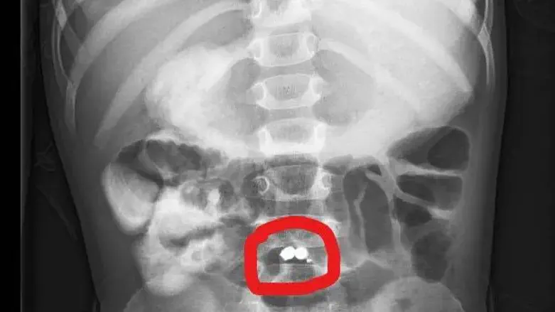 המגנטים שאותרו בגופו