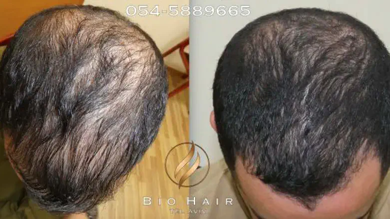 a PRP Treatment