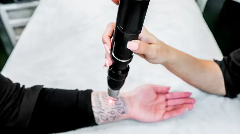 הסרת קעקועים בלייזר