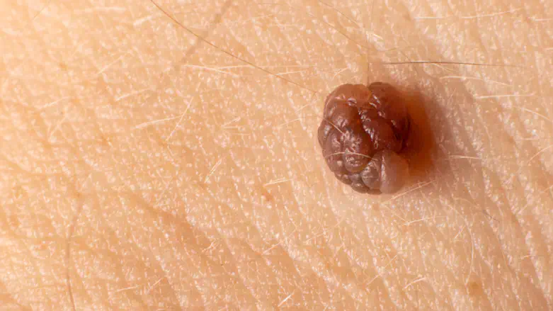 הסרת סרחי עור