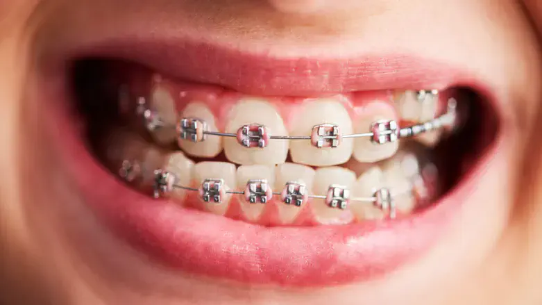 יישור שיניים עם קשתיות שקופות