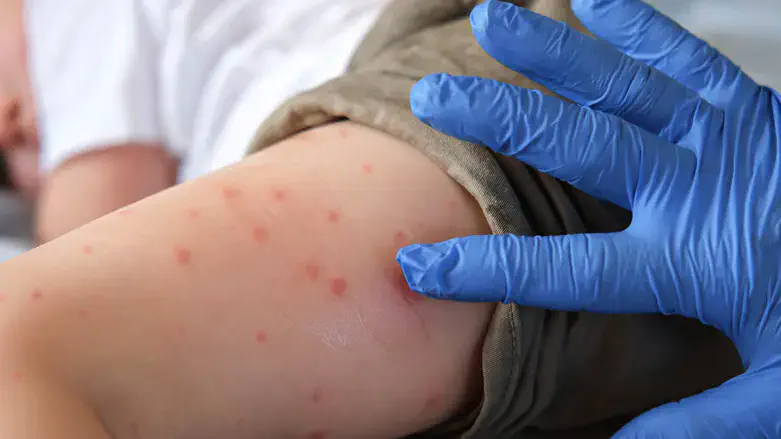 Measles (illustrative)