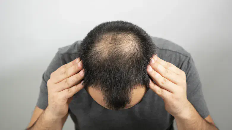 Hair Transplants