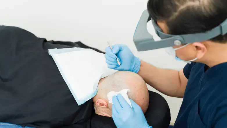 Hair Transplant