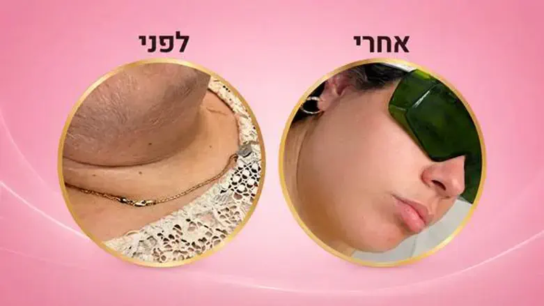 הסרת שיער