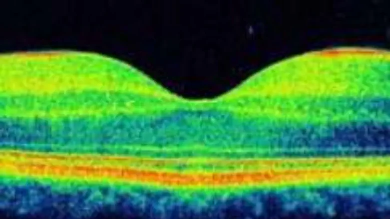 OCT-generated image of macular disease
