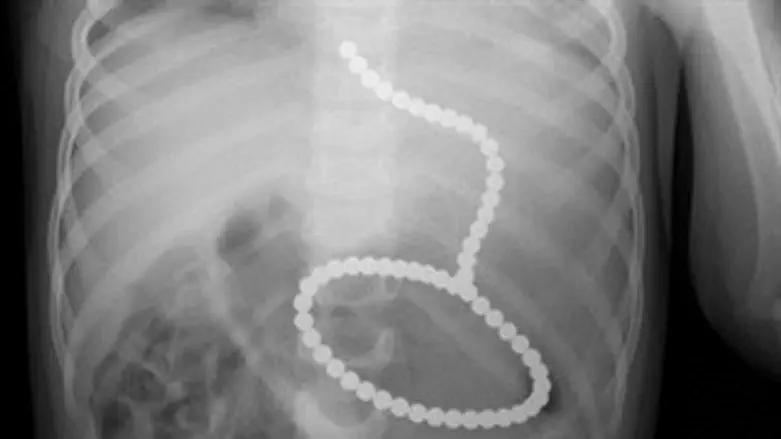 שרשרת מגנט בבטן הפעוט