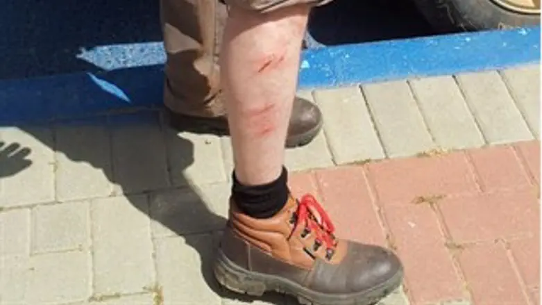 פציעות רגל ממוטות ברזל