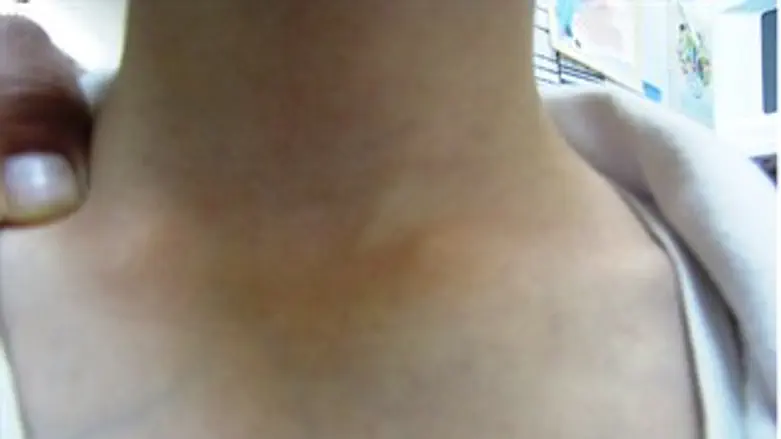 סימני החניקה