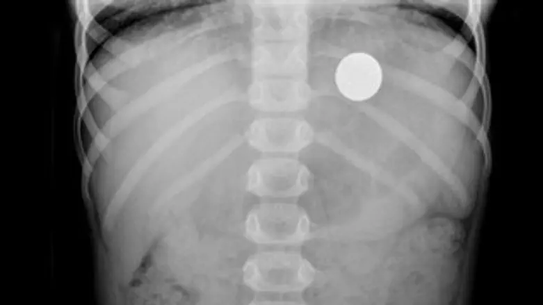 צילום הרנטגן של הפעוט