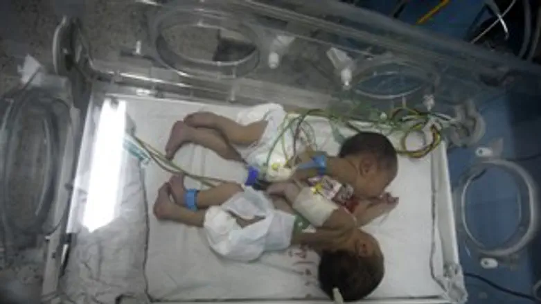 תאומים סיאמיים. ארכיון