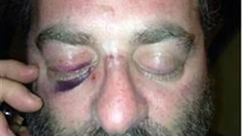 Tzuker's injured eye