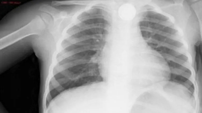 צילום הדמייה של אחד הילדים שבלע סוללה