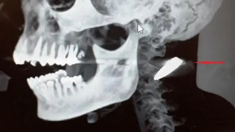 הקלי בצילום רנטגן