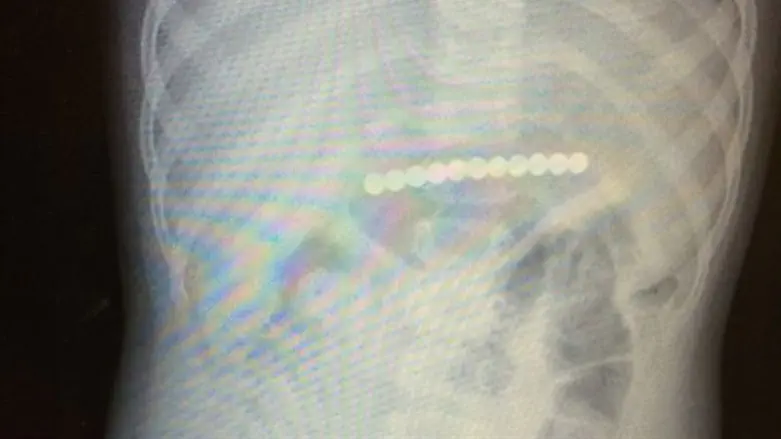 המגנטים בבטן הפעוטה