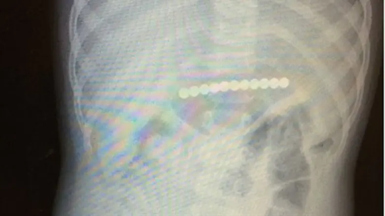 X-ray shows magnets in the infant's stomach