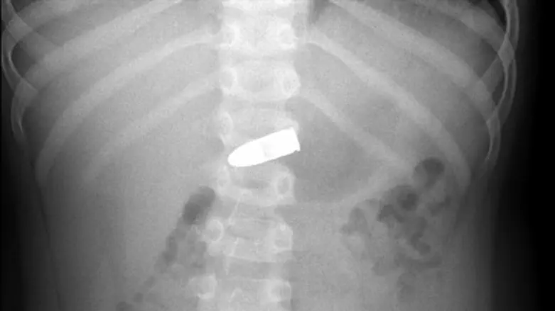 הקליע בגופו של הילד