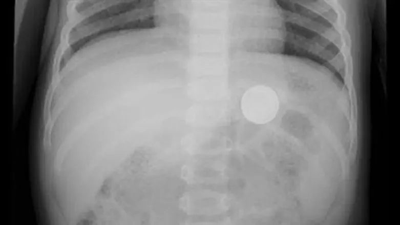 הסוללה בוושט