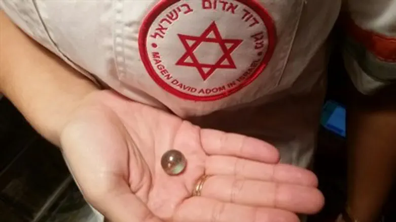 Marble extracted from wind pipe