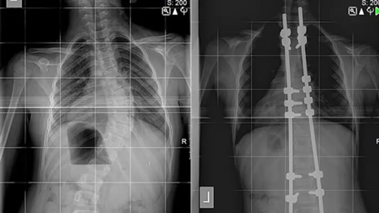 העקמת לפני ואחרי הטיפול