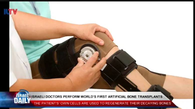Israelis perform world first artificial bone transplant