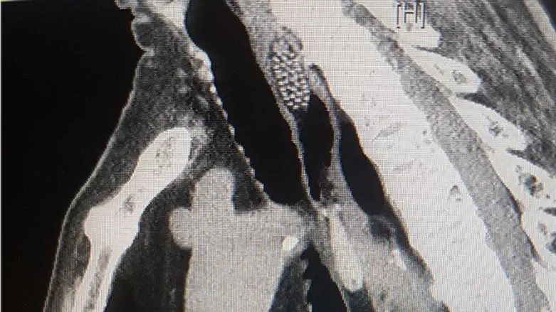 מברשת השיניים בגופו של הקשיש