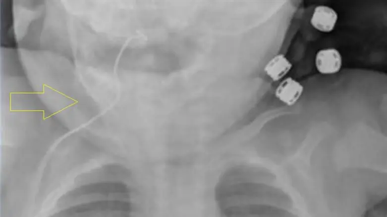 X-ray image of antenna inside child's throat