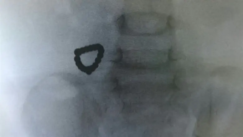 שרשרת מגנטים במעי