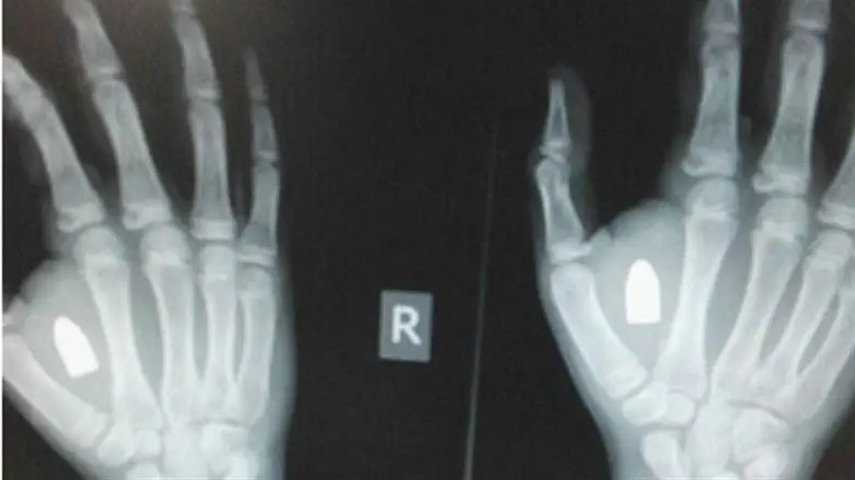 Bullet found in child's hand