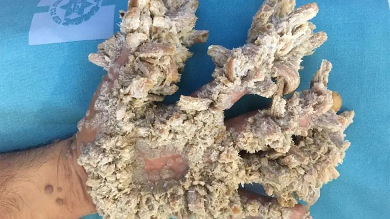 ידו של "איש העץ" לפני הניתוח