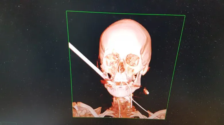 צילום הסיטי של נתנאל לפני הוצאת החץ