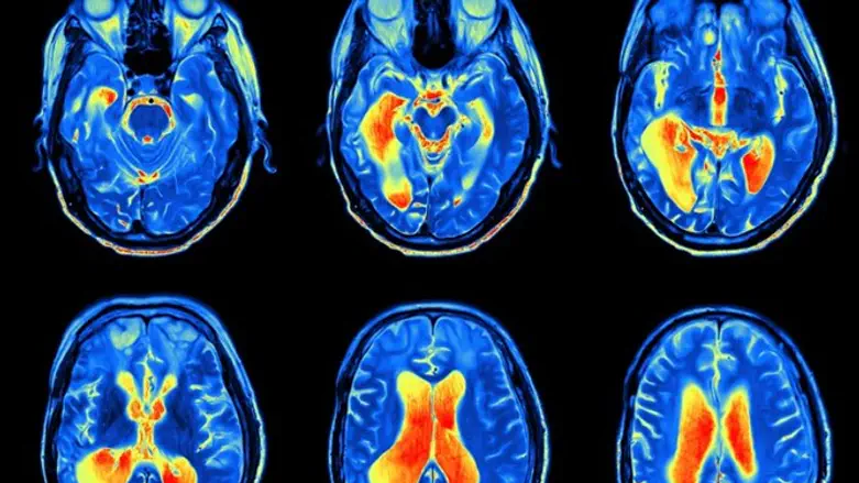 MRI scans of brain (illustrative)