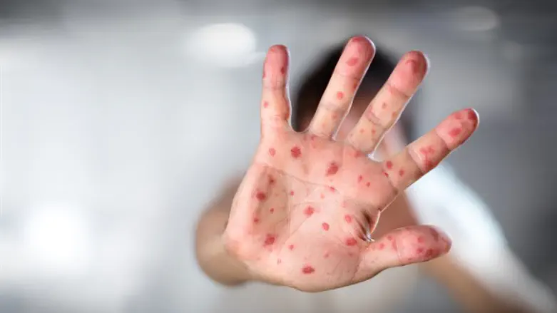 Measles