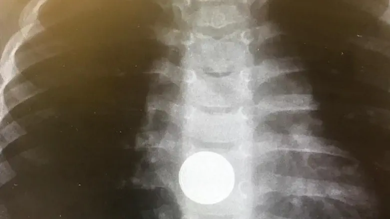 Battery stuck in esophagus