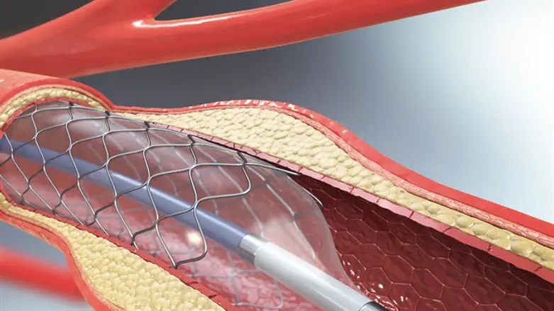 Heart catheterization (illustrative)