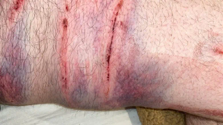 הפגיעה בנהג