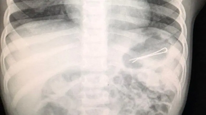 הסיכה בבטן הפעוט