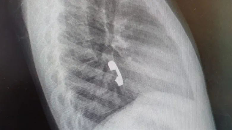 הטבעת תקועה בוושט