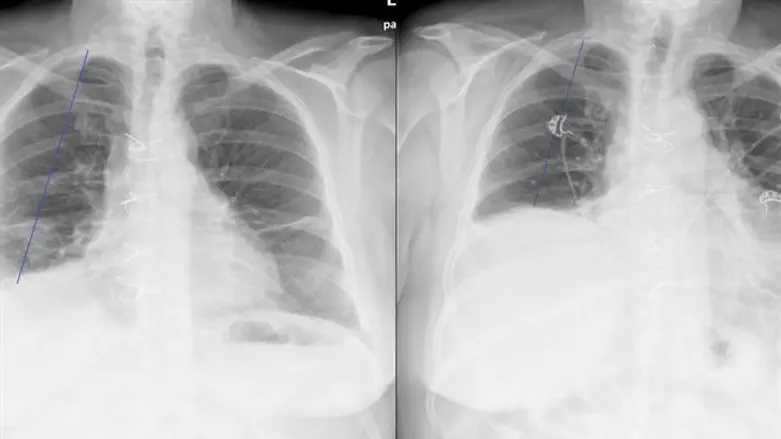 צילומי החזה לפני ואחרי