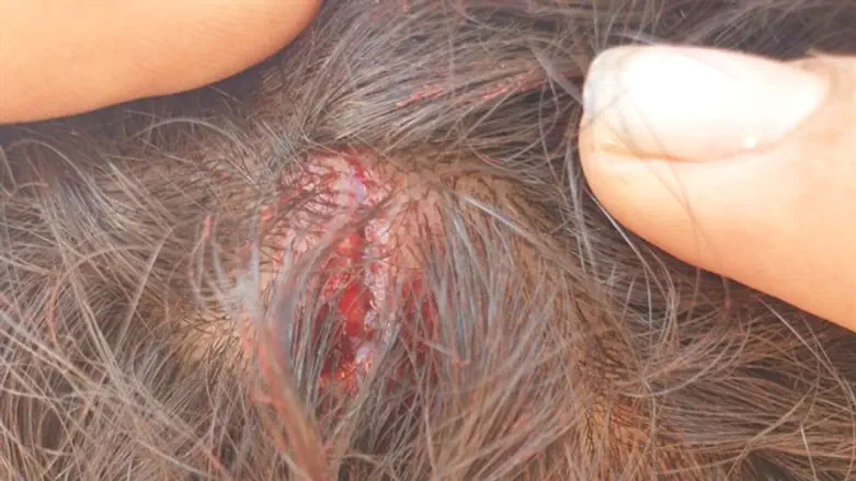 injured head of Jewish boy attacked in Hebron