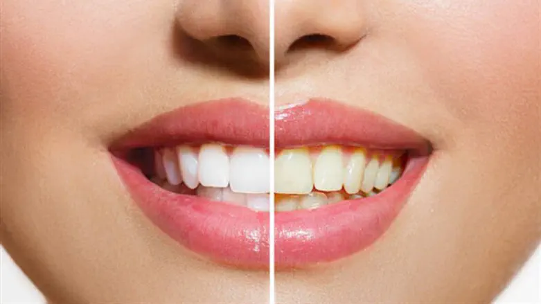 הלבנת שיניים. אילוסטרציה