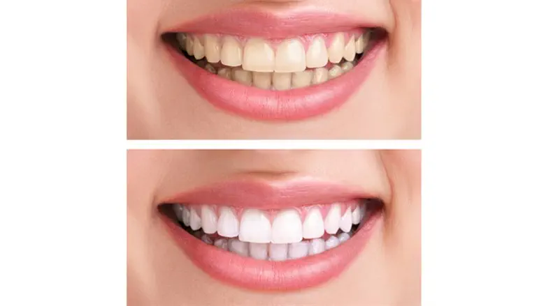 teeth whitening