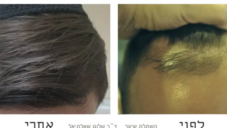 השתלת שיער