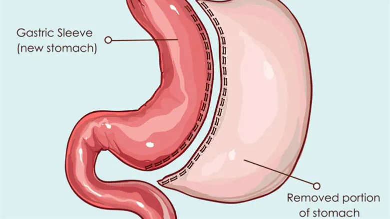 ניתוח שרוול