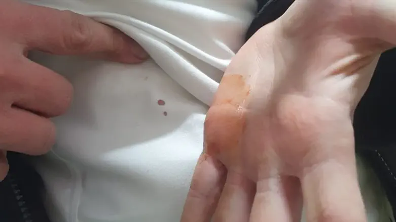 The injury to the victim's hand